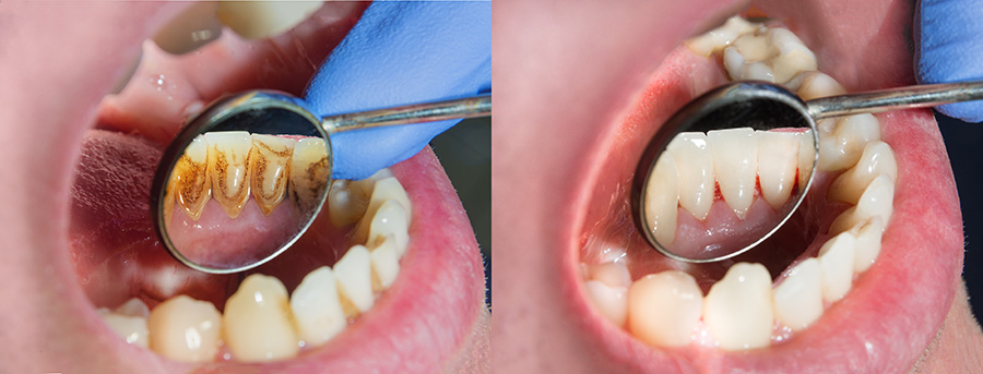 Dents avec taches examinées par le dentiste